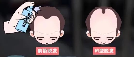 脱发后想增加发量，你可以用以下方法! 图片-5