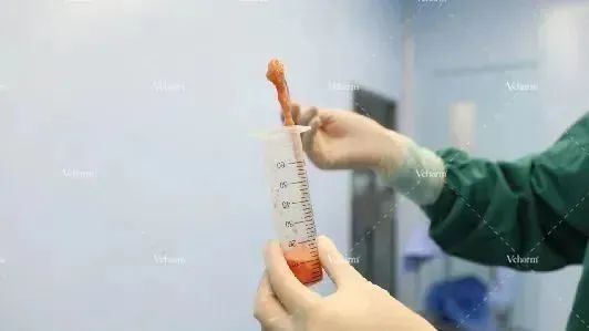 自体脂肪填充存活率与哪些因素有关? 图片-8