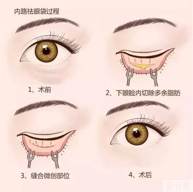 眼霜、眼部按摩仪祛不了眼袋，不要再花冤枉钱了! 图片-8