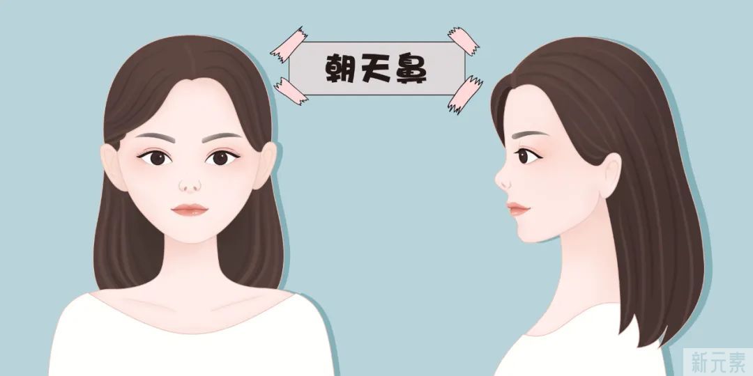 鼻孔外露很尴尬?做完矫正变更美 图片-2