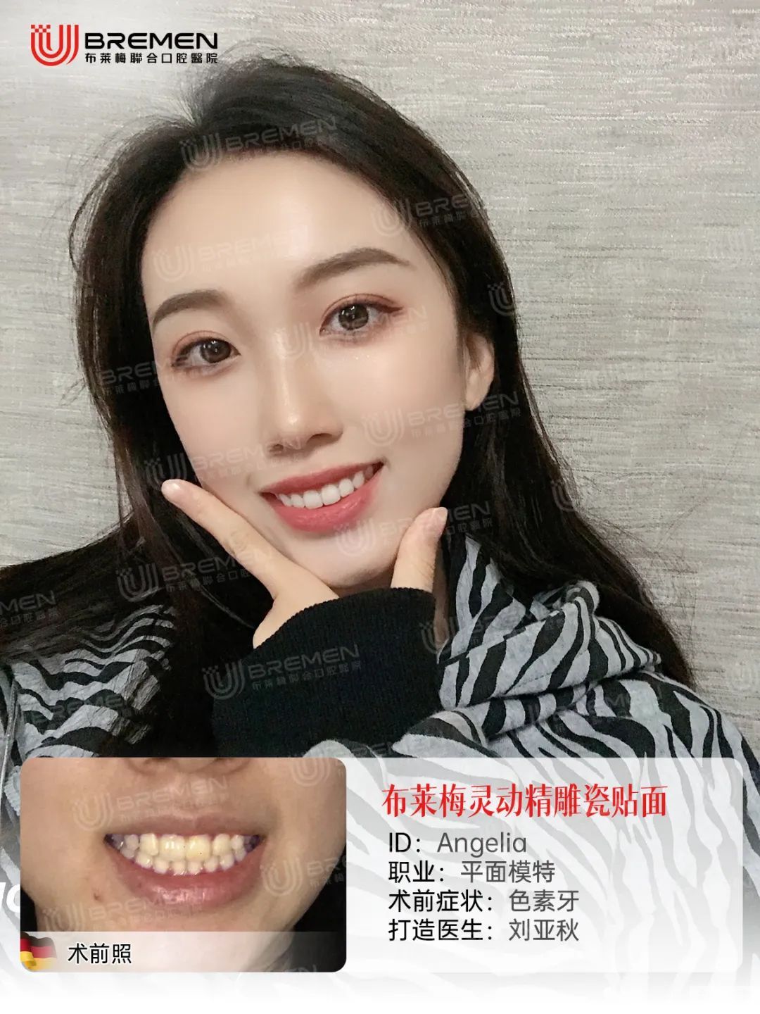 避坑指南 | 为什么贴面不能随便做?一文了解 图片-3