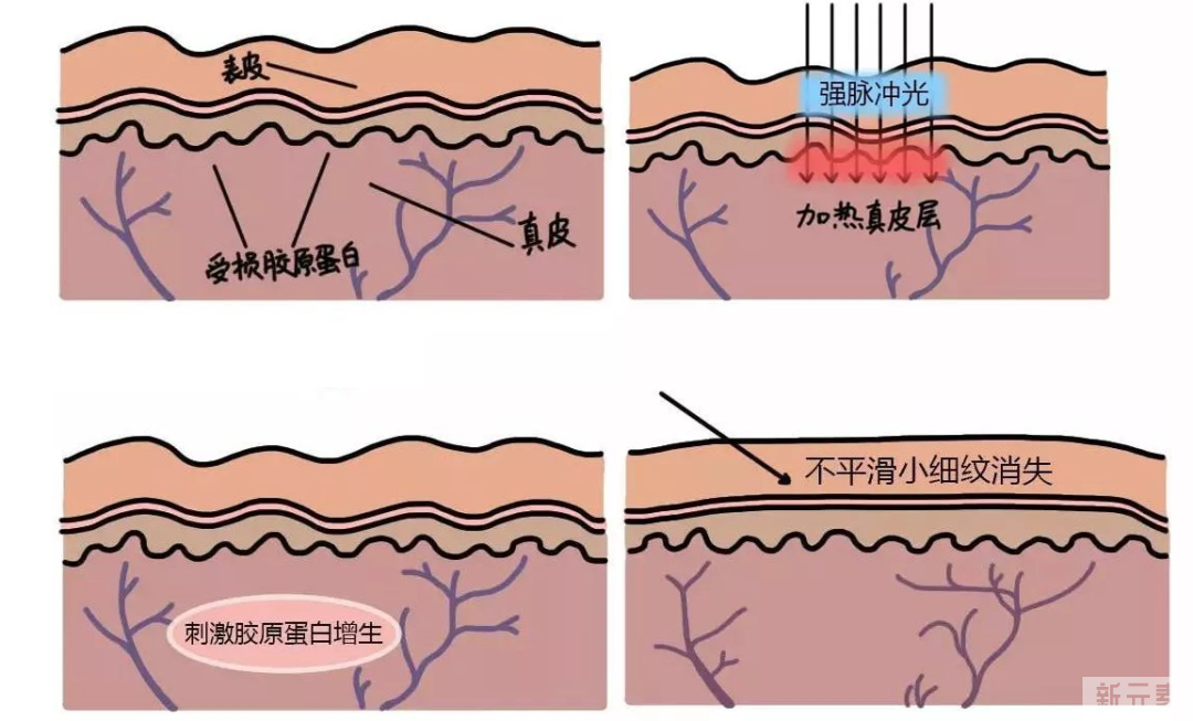 光子嫩肤会产生依赖吗?全模式和单模式怎么选?能维持多久?一文说清 图片-5