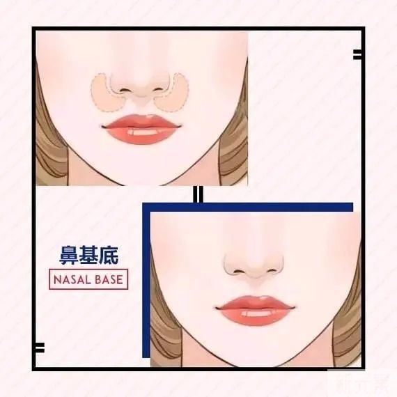 鼻基底填充到底有多重要? 图片-3