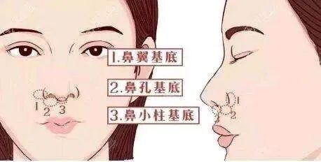鼻基底填充到底有多重要? 图片-7