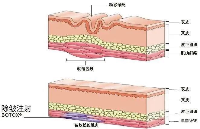 国产除皱和进口除皱有什么区别? 图片-5