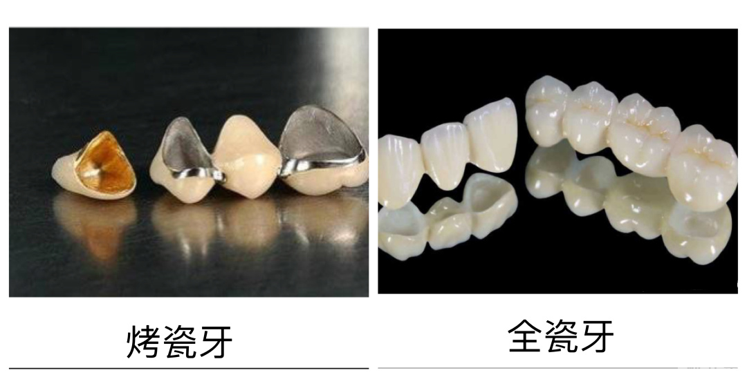 为什么大部分医生都不建议做烤瓷牙?拒绝烤瓷牙!看完你就懂了 图片-2