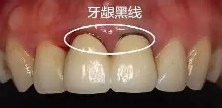 为什么大部分医生都不建议做烤瓷牙?拒绝烤瓷牙!看完你就懂了 图片-13
