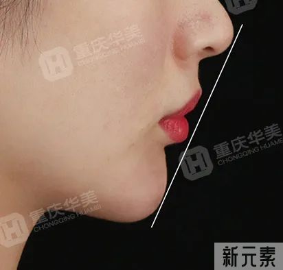 下巴短小、下巴后缩，玻尿酸和手术改善哪个更好? 图片-5