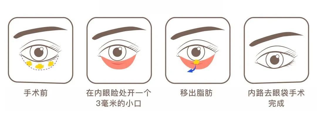 眼袋去不掉?看看你是不是做了这几件事? 图片-9