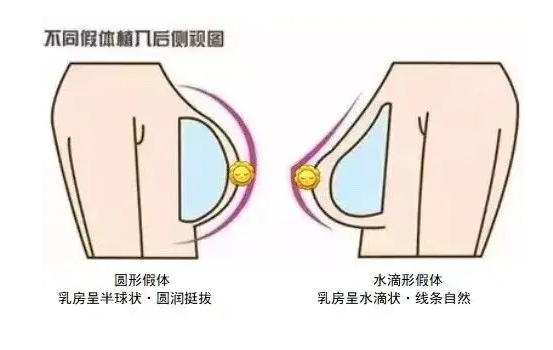 假体隆胸 | 水滴形和圆形假体该怎么选择? 图片-8