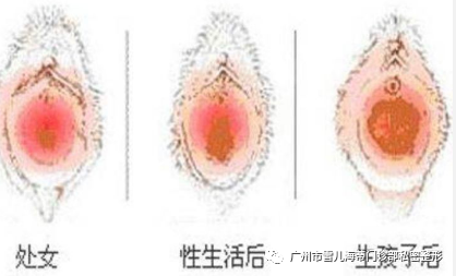 处女膜手术还能量身定制? 图片-3