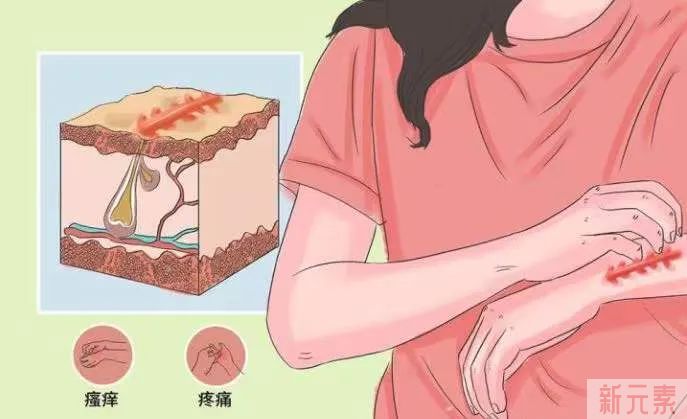 ​增生疤为何会发痒?原来跟这4个因素密不可分! 图片-7