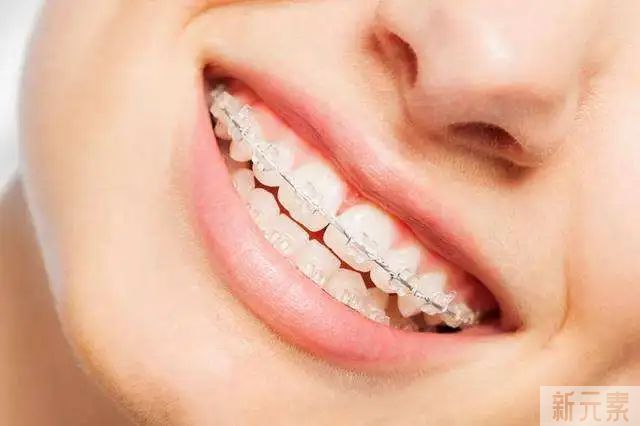 深度讲解:6种牙齿矫正方式!看完不再纠结牙套的选择! 图片-6