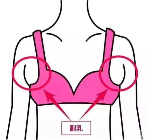 想要切除副乳又怕痛?你还可以选择—— 图片-6