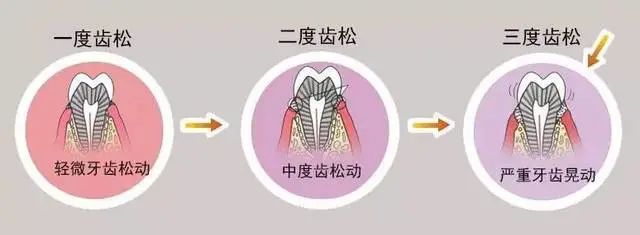 聊医聊 | 牙齿松动了，拔还是不拔? 图片-5
