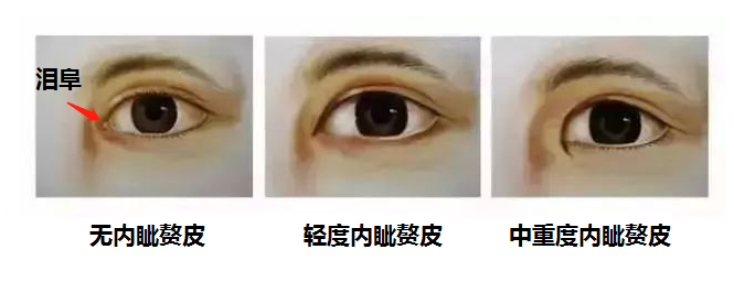 想做双眼皮，医生却让我开眼角，真的有必要吗? 图片-2