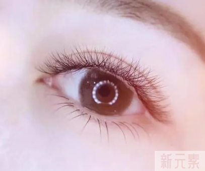 想做双眼皮，医生却让我开眼角，真的有必要吗? 图片-4