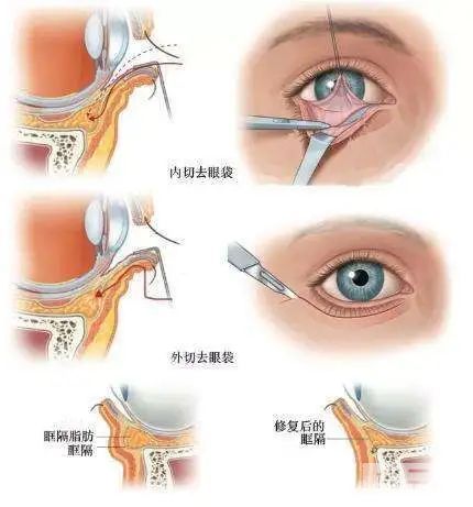 祛眼袋手术可能会出现什么问题呢? 图片-2