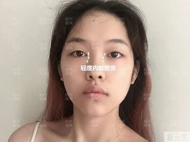 想让眼睛变大，一定要开眼角吗? 图片-5