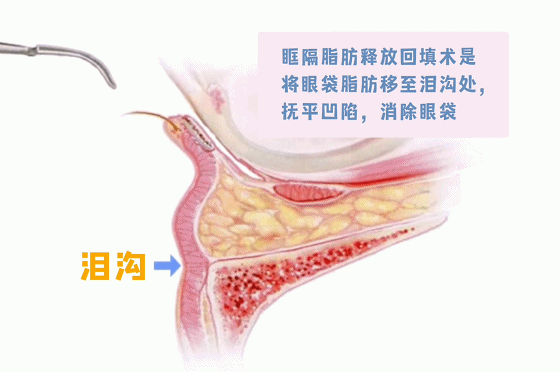 肿眼泡、眼袋、眼窝凹陷，三个不同的问题，都是TA在作妖 图片-6