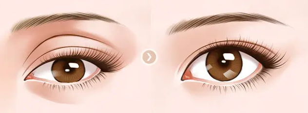 肿眼泡、眼袋、眼窝凹陷，三个不同的问题，都是TA在作妖 图片-9