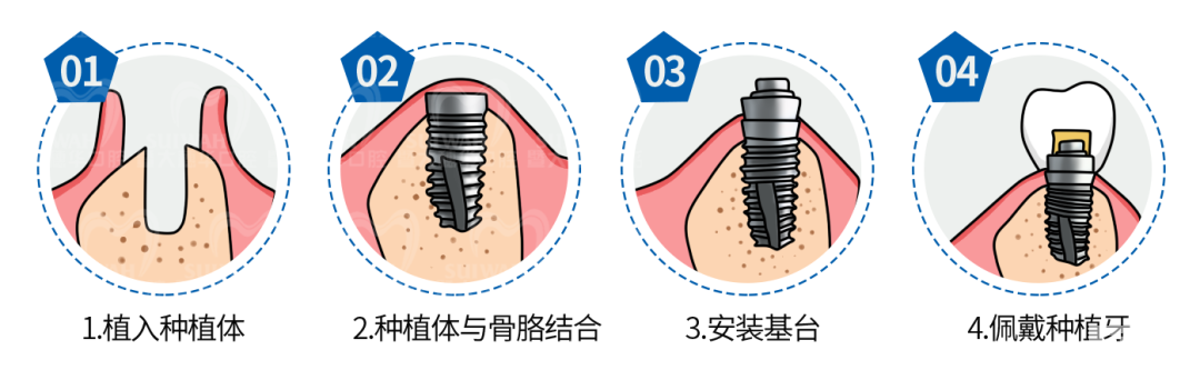 为什么有的人种牙要3个月，有的人当天就种上了? 图片-5