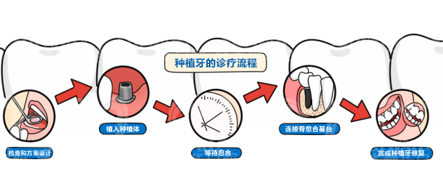 为什么有的人种牙要3个月，有的人当天就种上了? 图片-3