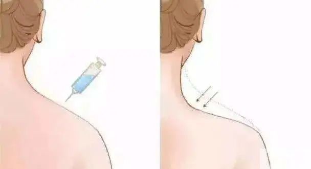 如何有效消除“富贵包”，选对方法很重要 图片-4