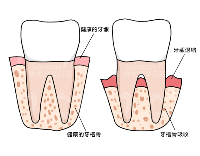 你的牙龈线是如何一点一点往下移的? 图片-6