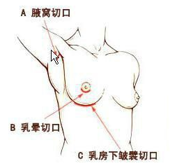隆胸手术切口越小，术后的痕迹越小吗? 图片-3