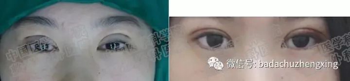 双眼皮和上睑下垂有什么关系 图片-5