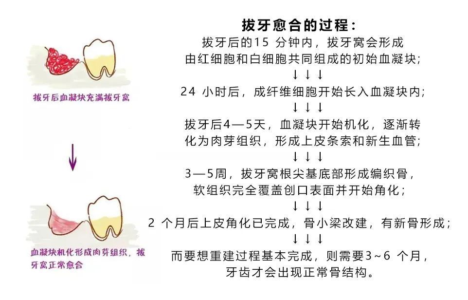 拔完牙后，该怎么刷牙呢?牙窟窿又是如何愈合的? 图片-5