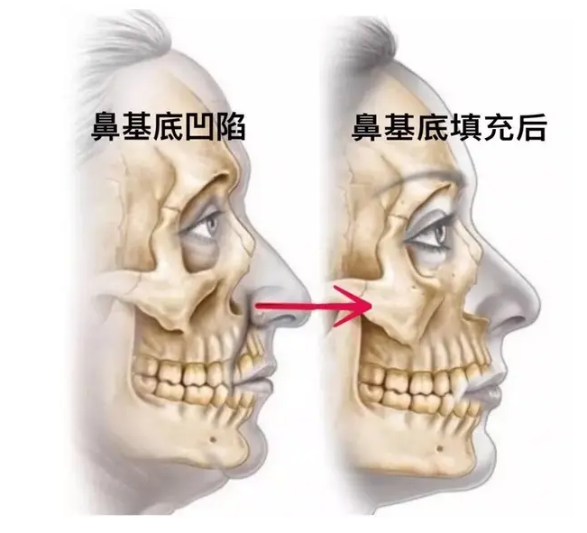 法令纹与鼻基底凹陷有何关系? 图片-6