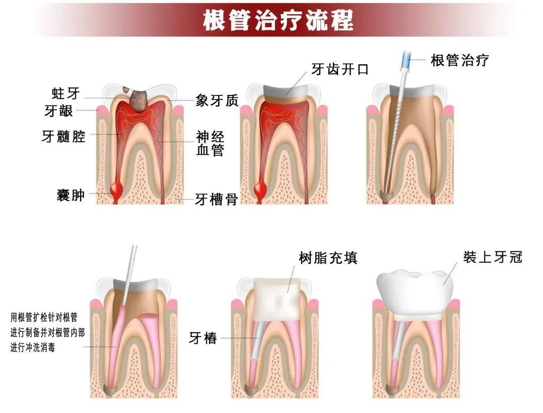 牙齿反复痛后又不痛了，是自愈了吗?还要不要看牙医? 图片-7