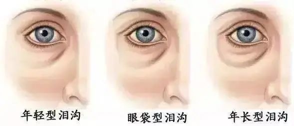 用掉的遮瑕绕地球一圈...“泪沟隐形术”到底有没有破绽? 图片-6