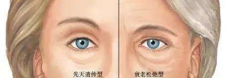 用掉的遮瑕绕地球一圈...“泪沟隐形术”到底有没有破绽? 图片-10