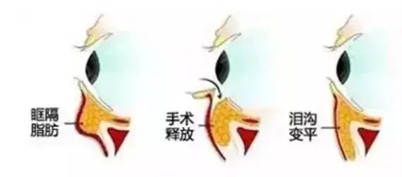 用掉的遮瑕绕地球一圈...“泪沟隐形术”到底有没有破绽? 图片-9