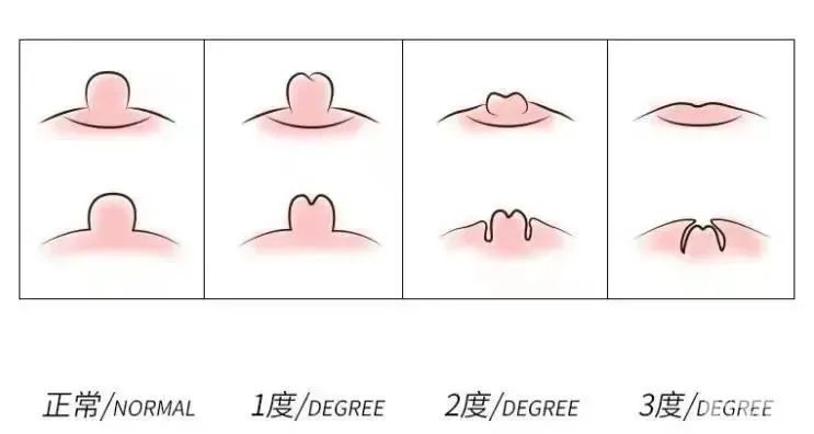 乳头藏猫猫，宝宝吃不到，新妈妈痛苦中选择手术 图片-8