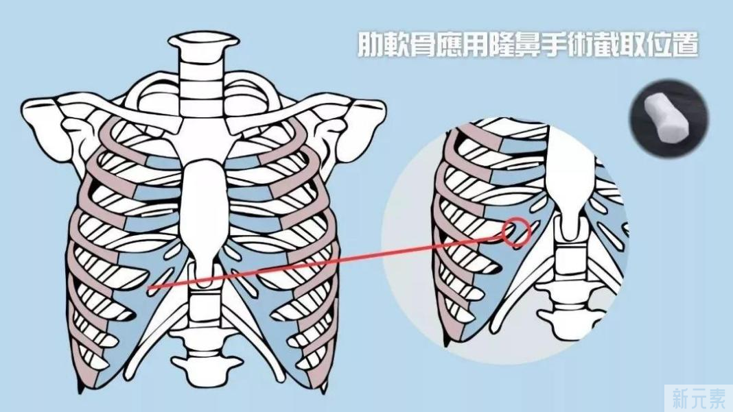 自体软骨隆鼻要怎么选? 图片-3