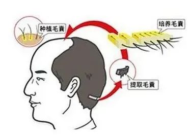 干货|毛囊利用率与植发手术成功率的关系! 图片-4