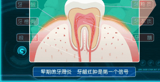 科普来了 | 对象有牙周病会传染给我吗? 图片-5