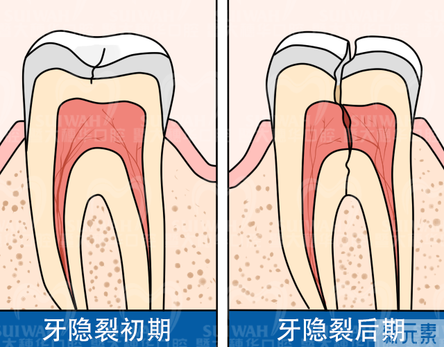 没蛀牙却又牙齿痛?有可能是你的牙齿裂了! 图片-4