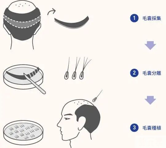 植了个寂寞?植发后依旧秃是怎么回事? 图片-7