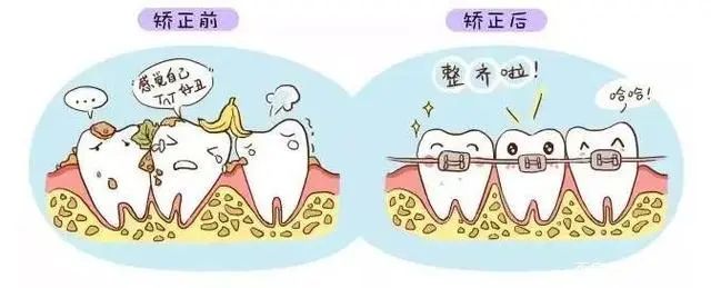 牙齿矫正移动的原理，拒绝满口乱牙! 图片-5