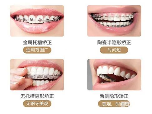 牙齿矫正移动的原理，拒绝满口乱牙! 图片-11