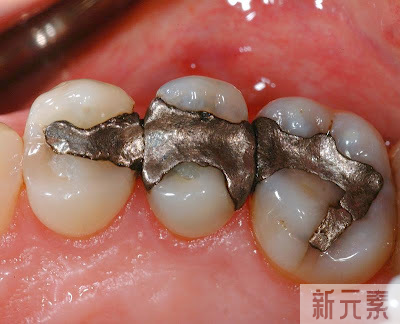 科普来了 | 价格不一的补牙材料有什么区别?该怎么选? 图片-7