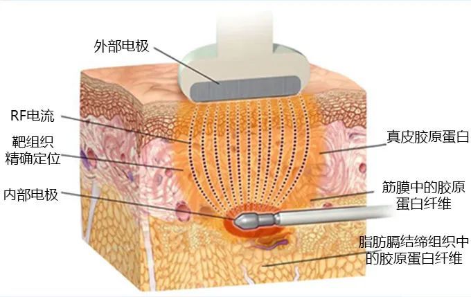 吸脂和光纤溶脂该怎么选? 图片-3