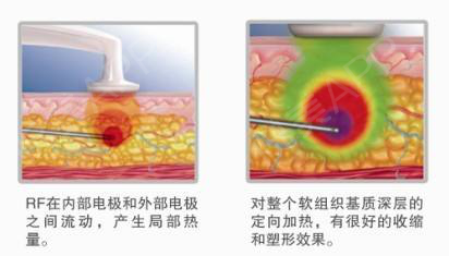 吸脂和光纤溶脂该怎么选? 图片-5