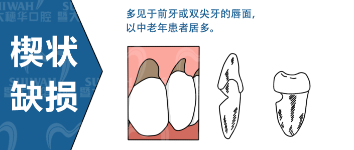 刷牙时感觉牙酸?小心是楔状缺损! 图片-4