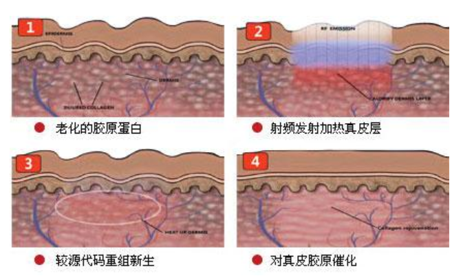 科普篇丨光子、射频、激光哪个更适合你? 图片-3